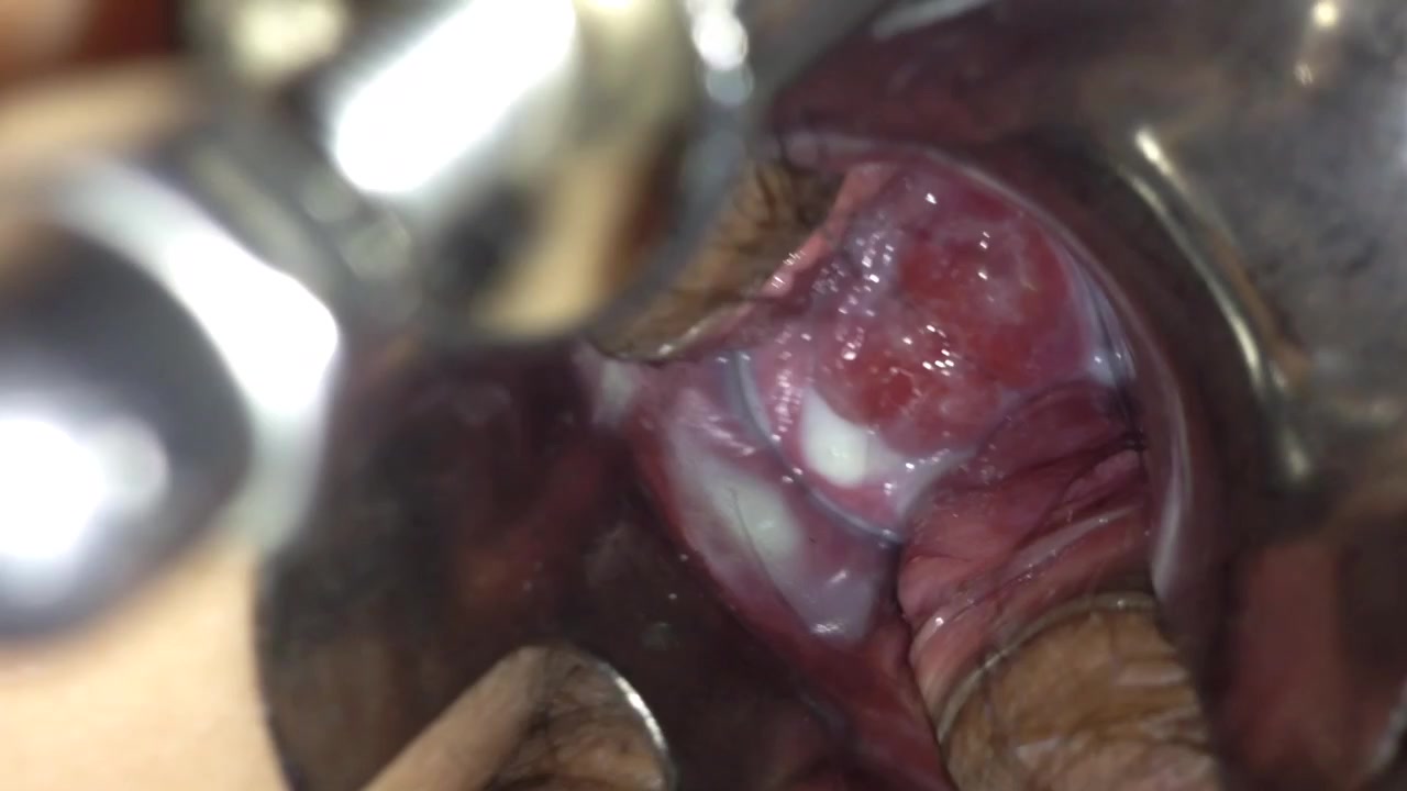 温度计插子宫口